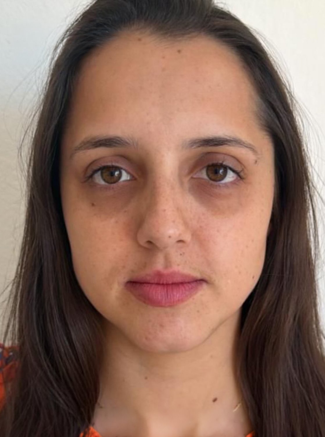 Resultado botox