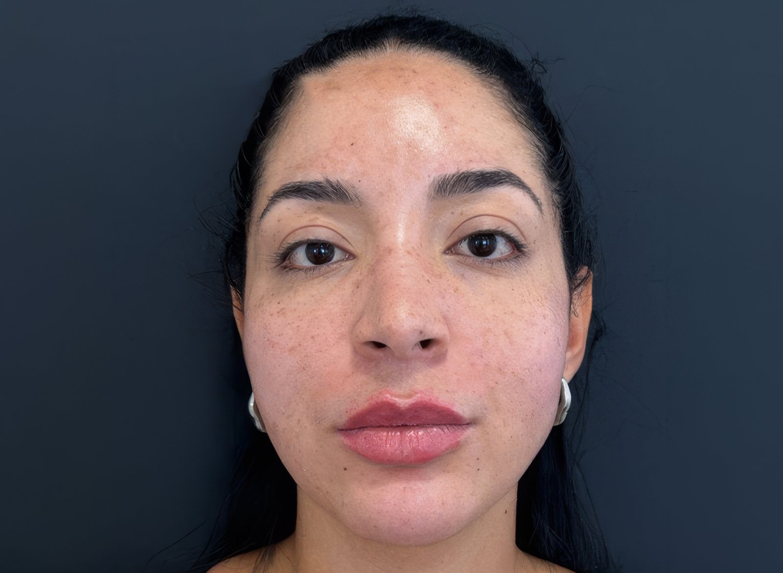 Resultado de Harmonização Facial