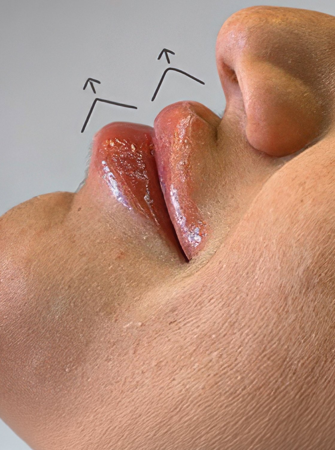 Resultado de preenchimento labial